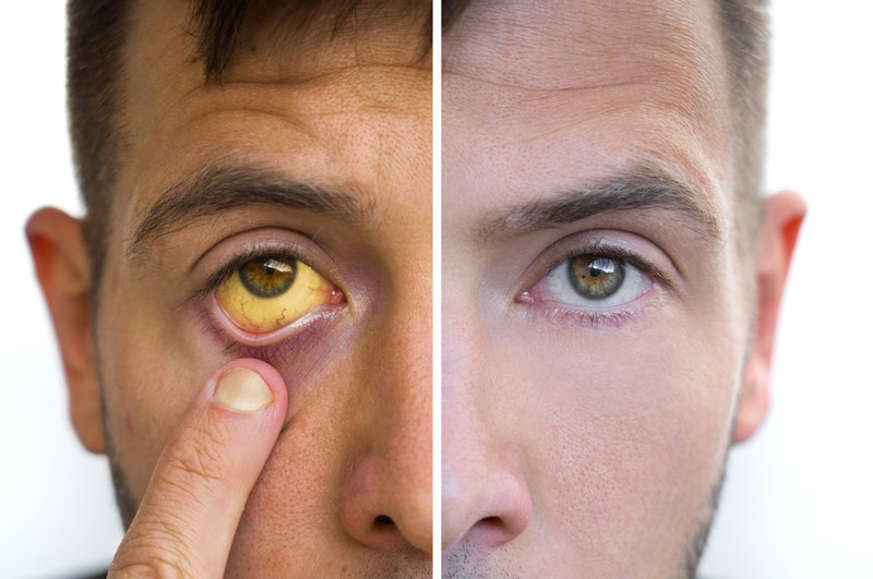 Jaundice Liver disease