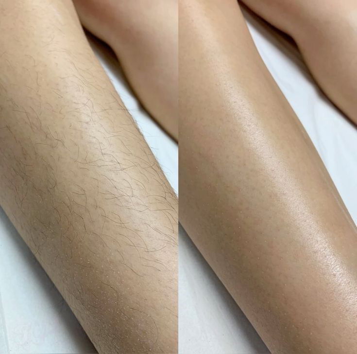 Laser-Hair-Reduction