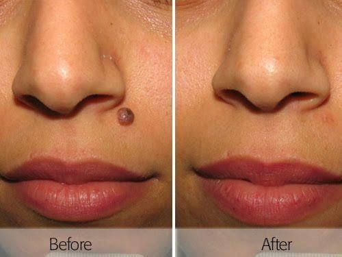 Mole-removal