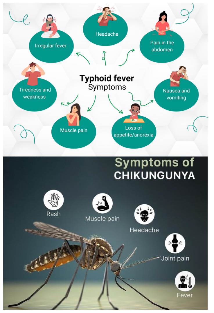 Typhoid