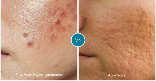 acne
