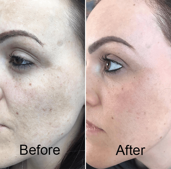 PRP-Skin
